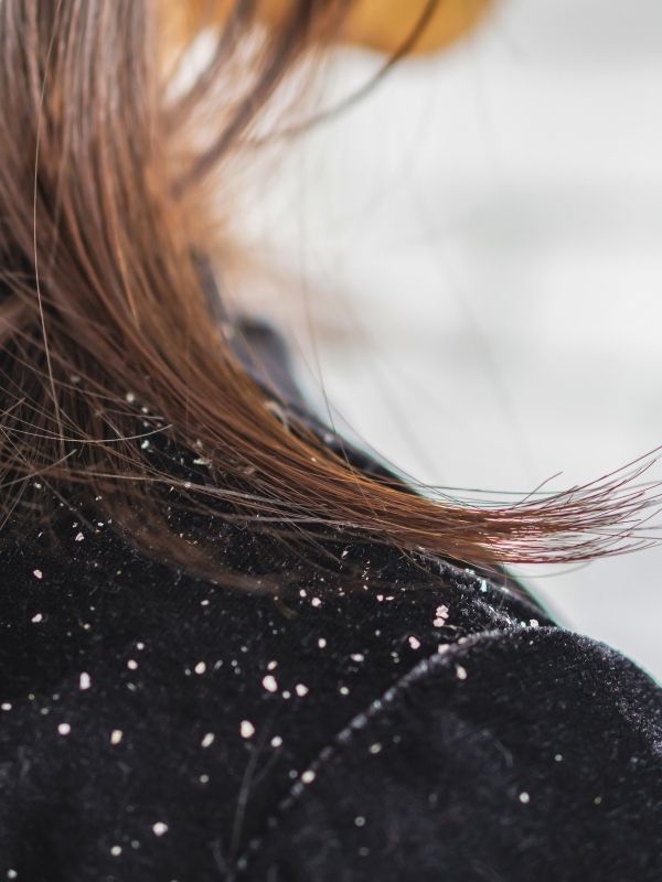 L'épaule d'une femme couvert de pellicule (pityriasis simplex) qui a un cuir chevelu sec